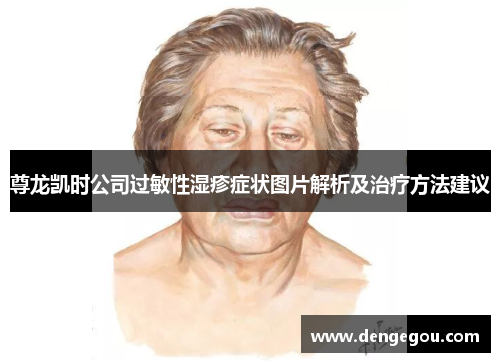 尊龙凯时公司过敏性湿疹症状图片解析及治疗方法建议